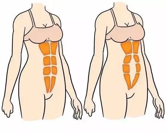 你的腹直肌分离了吗？一步就知道